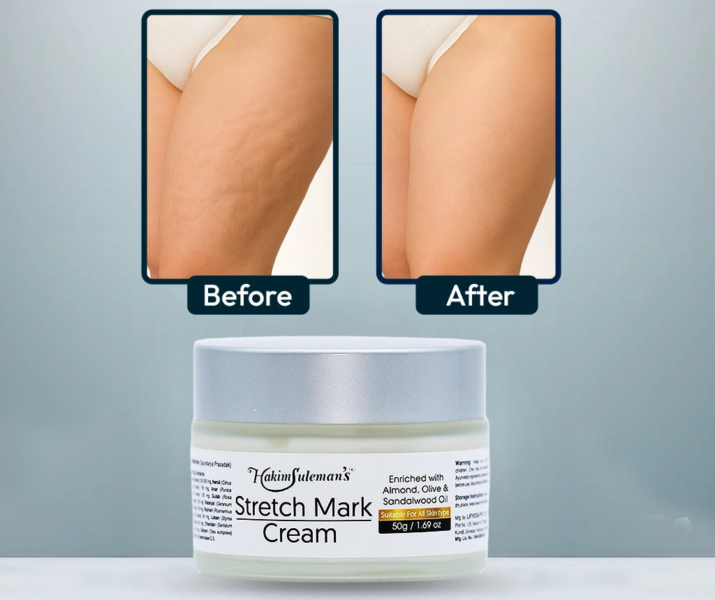 Stretch Mark Cream