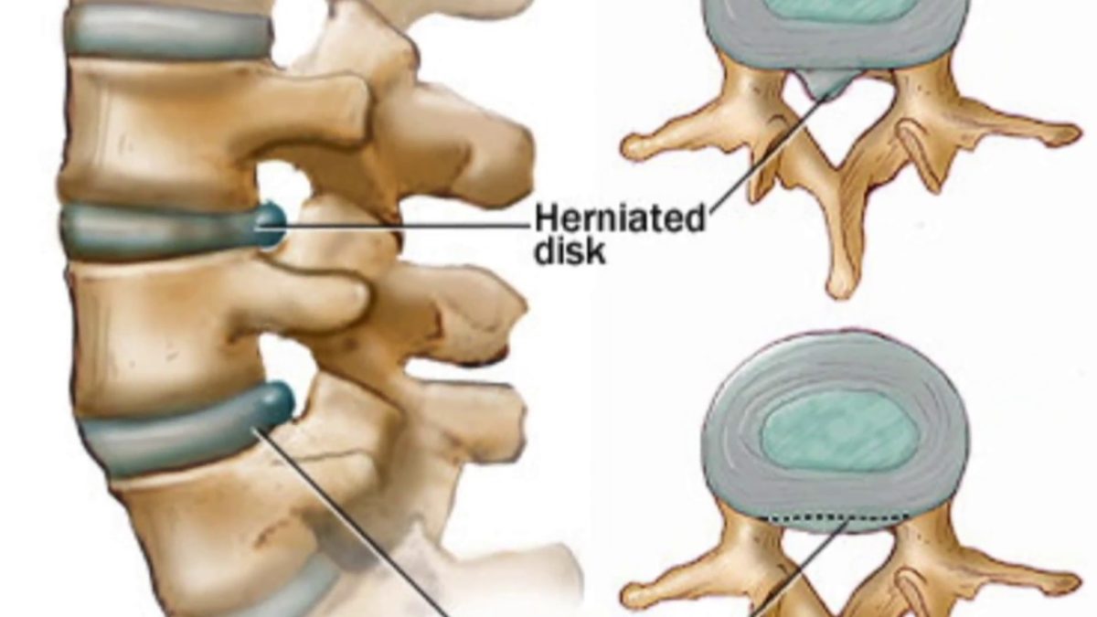Протрузии дисков позвоночника поясничного отдела