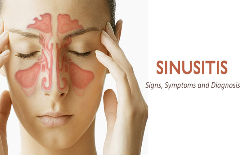 sinusitis