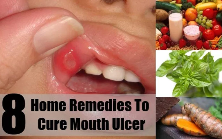 essential-home-remedies-for-mouth-ulcers-femina-in